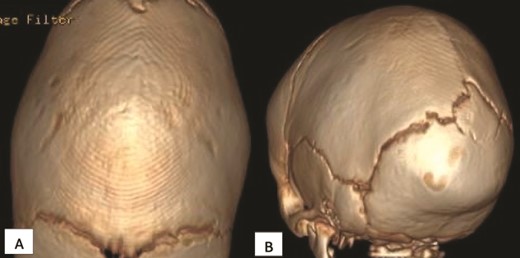 Initial computed tomography scan (CT) scan obtained when the patient was 3 months old showing sagittal craniosynostosis. (A) Superior axial view and (B) posterior view.