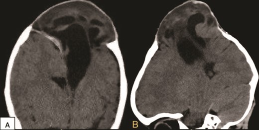 Preoperative coronal (A) and sagittal (B) brain CT scan demonstrating the encephalocele.