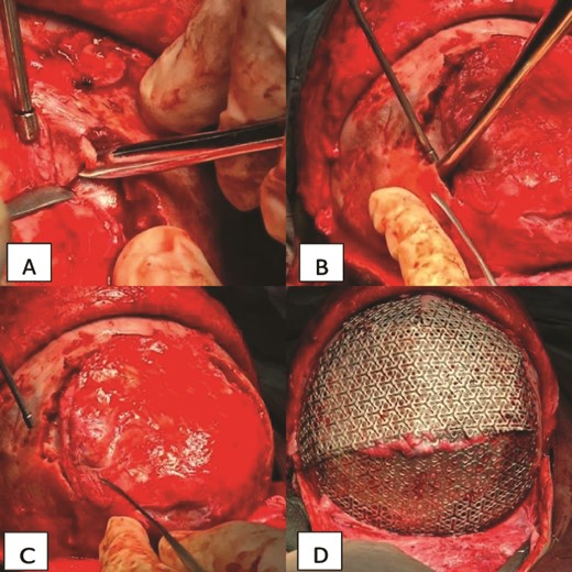 Intraoperative view of the case. (A) Showing the ossification and adhesion of the bone to the brain tissue. (B) Showing the cutting technique used to separate the bone. (C) Showing the brain tissue separated from the bone and free. (D) Showing the cranial mesh inserted to cover the cranial defect and protect the brain tissue.