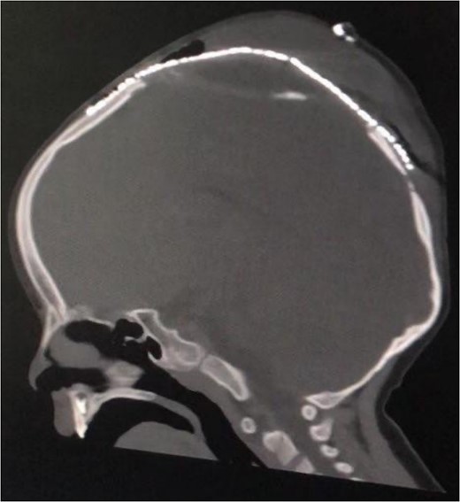 Postoperative sagittal brain CT demonstrating that the brain was inside the cranium and covered by the cranial mesh, preventing further bulging.