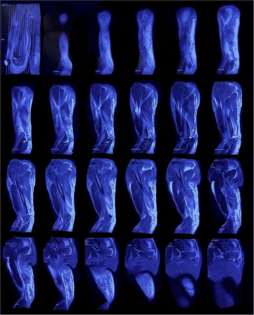 Left arm magnetic resonance imaging with evidence of a triceps tendon rupture.