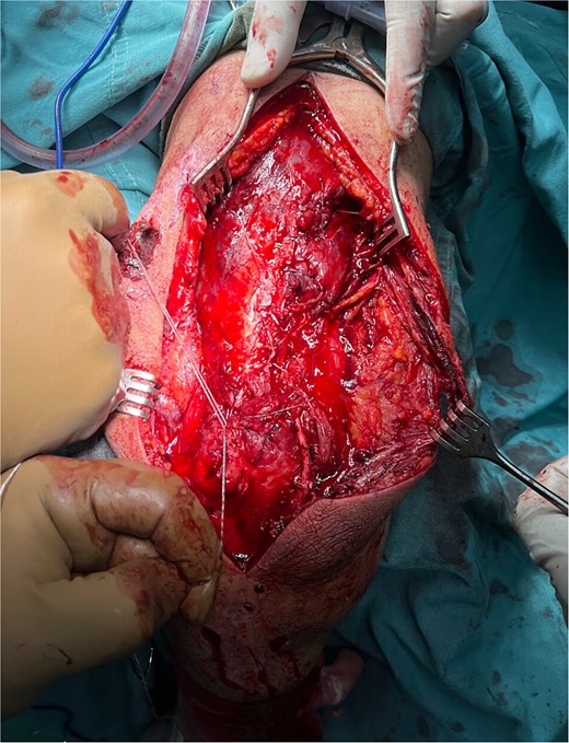 Left arm open triceps tendon repair with placement of modified Krackow suture technique and anchor suture on the olecranon tip.
