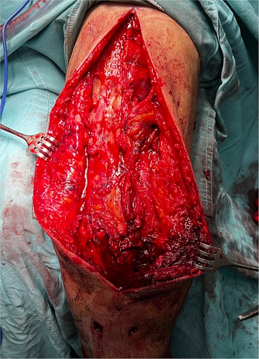 Left arm triceps tendon open surgical repair with a modified Krackow suture technique and anchor suture on the olecranon tip.