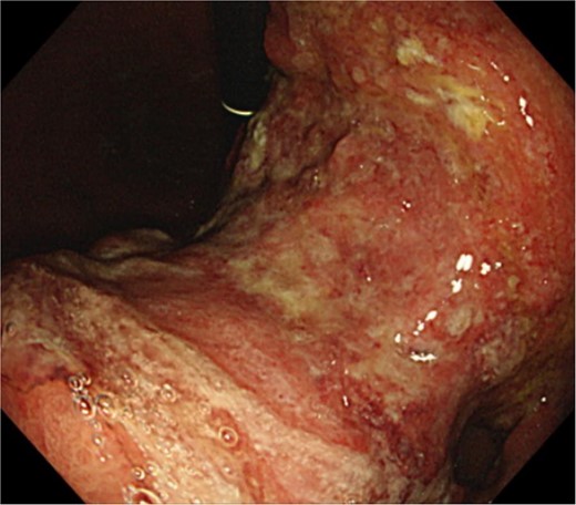 Clinical findings of endoscopy. Upper endoscopy showing a large tumor from body to antrum of the stomach.