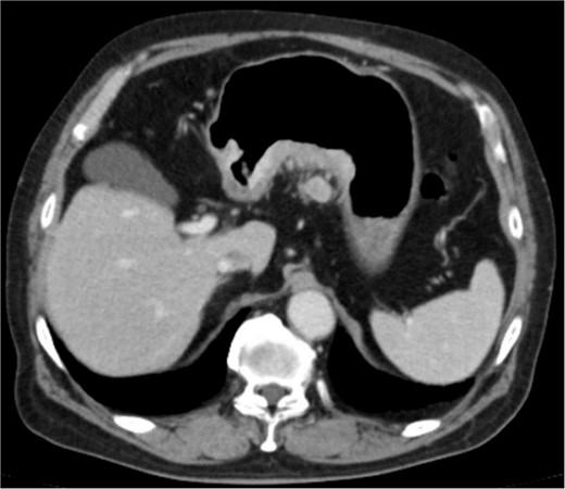 Clinical findings of contrast-enhanced CT. CT revealed the thickness of gastric wall and enlarged lymph nodes of lesser curvature side.