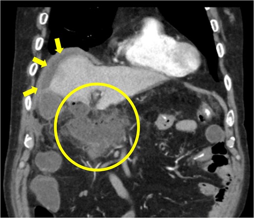 Diagnosis of postoperative duodenal perforation. CT showed ascites in subdiaphragmatic space (arrow) and around duodenal stump (circle) at POD 8.