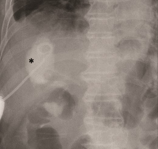 Primary drainage for duodenal fistula. As percutaneous approach, we inserted a pig-tail drainage tube to subdiaphragmatic space (asterisk) using X-ray fluoroscopy.