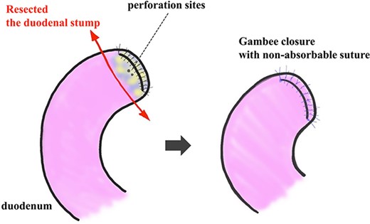 Resection and closure for two fistulas of the duodenum. Two pinhole perforation sites of the duodenum at the side of the anterior wall near the stump were identified. We resected the vulnerable duodenal stump, including the perforation site, by surgical scissor and close it by the interrupted single-layer suture (Gambee’s method) with unabsorbable 4–0 proline.