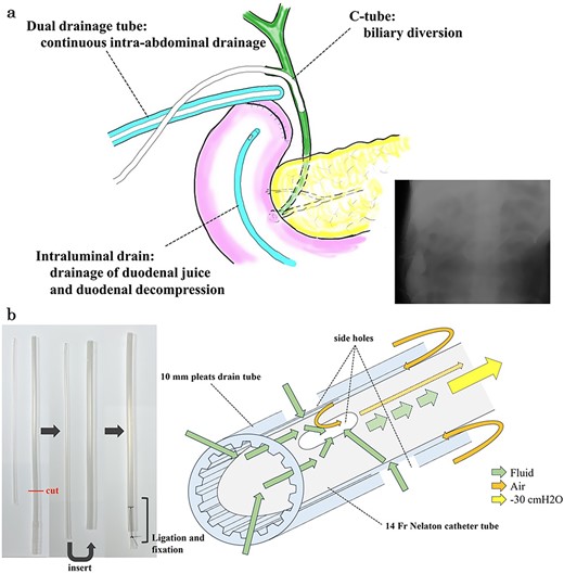 Multiple drainage system for the DSF and dual tube for continuous intra-abdominal suctional drainage and procedure of making. (a) In the reoperation, we placed three drainage systems for DSF: a C-tube from the cystic duct into the common bile duct, a dual drainage tube around the duodenal stump with continuous suction, and an intraluminal drain via the duodenum near the stump. (b) The dual drainage tube was made of 10 mm pleats and a 14 Fr Nelaton catheter tube. First, the tail of 10 mm pleats drain tube was cut. Secondly, 14 Fr Nelathon catheter tube was inserted into 10 mm pleats drain tube. At last, the tail of each tube was secured with ligation using 2–0 silk thread. Since there was airway between the outer tube and inner tube, it was possible to continuously discharge the intra-abdominal fluid without damaging the tissue due to negative pressure.