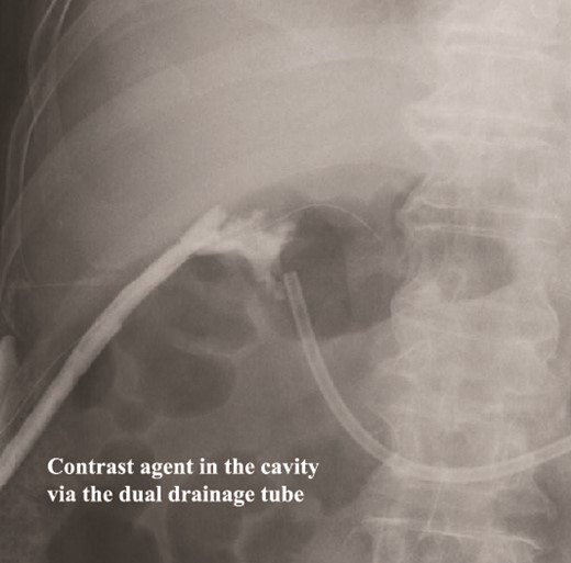 Fistulography locates the cavity, and the fistula is closed. As there was no flow of the contrast agent into the duodenum, we located the cavity around the duodenal stump.