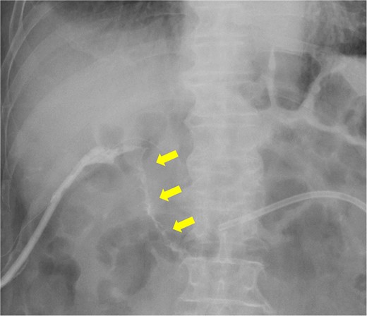 Fistulography reveals recurrence of the duodenal fistula. Fistulography at POD 44 showed recurrence of the duodenal fistula (arrows).