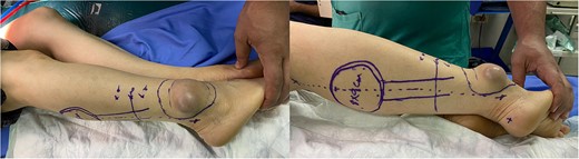 Gross views of the mass and the sural flap drawings at the operation table.