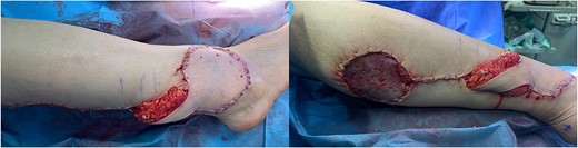 Gross views of the reconstruction area postoperatively.