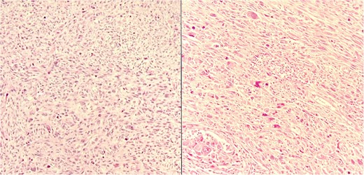 Histologic sections of the resected tumor.