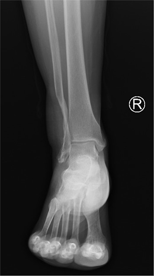 Ankle AP X-ray after 1 year of follow-up.