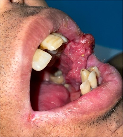 Patient with squamous cell carcinoma of the inner side of the left cheek.