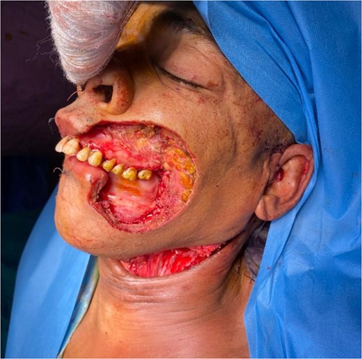 Loss of substance after tumor excision.