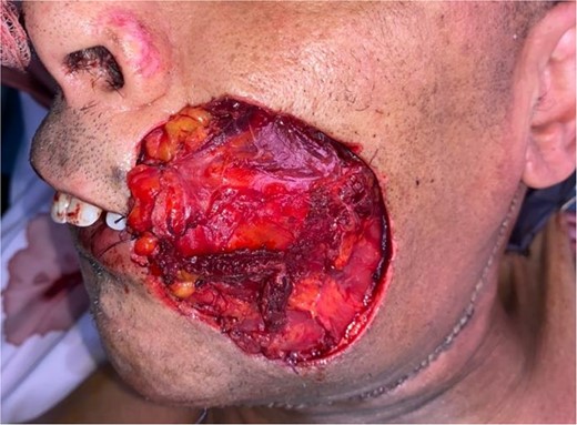 PMMF, intraoral skin palette.