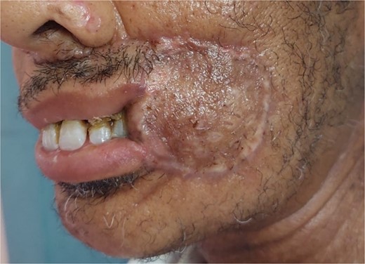 Result after skin graft.