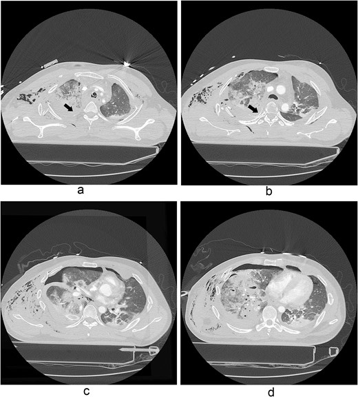 A contrast-enhanced chest CT scan after blunt chest trauma. Chest radiograph showed right hemopneumothorax and left hydropneumothorax. Multifocal extensive hemorrhage/pneumatocele formation was visible on the right side along with combined active bleeding (arrows) in the right lung.