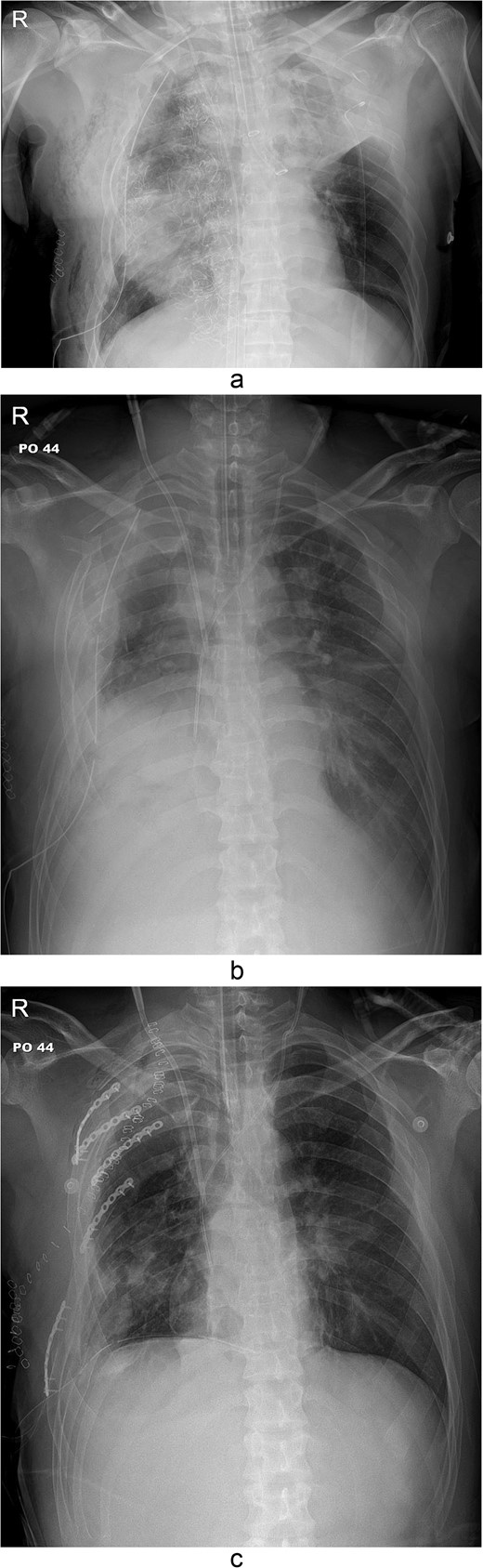 Simple radiographs obtained after each operation. (a) Radiograph after the first operation. Gauze, which is visible as a wavy white line, was packed in the right thoracic cavity. Multifocal opacity was seen in the right lung, and there was left upper lung atelectasis. ECMO catheters were placed in the IVC. (b) Radiograph following the second operation. The right ribcage is narrowed due to displaced fractured ribs. (c) Radiograph after the third operation. Five plates were applied to the fractured ribs.