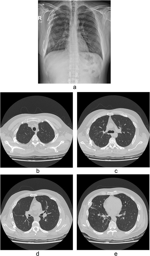Chest radiograph and CT scan 10 months after the accident. (a) Chest radiograph showed well-healed fractured ribs and expanded lungs without active lesions. (b)–(e) Non-enhanced axial chest CT images showed recovery from injury.