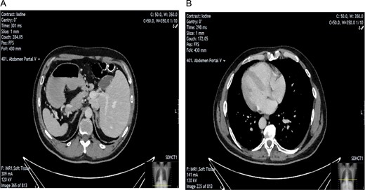 CT scan showing evidence of SIT. Image A shows position of gallbladder and evidence of nodularity. Image B showing dextrocardia indicative of SIT.