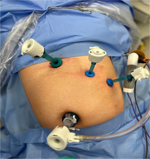 Intra-operative image taken illustrating laparoscopic port setup.