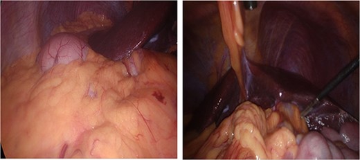 Anatomical variation with anatomical left lobe of the liver and fundus of the stomach in right upper quadrant (RUQ) and gallbladder in left upper quadrant (LUQ).