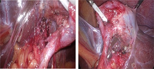 Critical view of safety with plane of dissection lateral to line of safety; two structures are viewed both entering the gallbladder and the lower border of the gallbladder dissected from the liver.