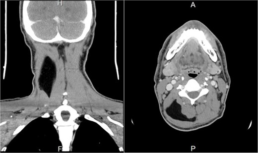 Preoperative contrast-enhanced CT image. (A) A coronal section shows a right hypodense mass between the trapezius and splenius capitis muscle. (B) Axial section shows a right hypodense mass between the trapezius and splenius capitis muscles.