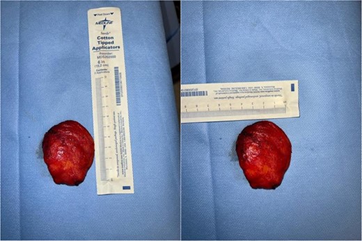 Surgical specimen.