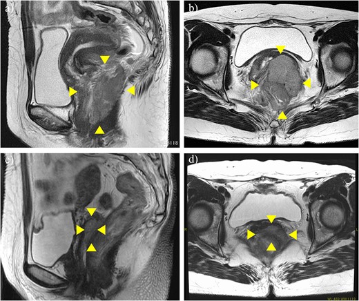MRI before neoadjuvant chemotherapy (a, b) and after two cycles of paclitaxel and cisplatin (c, d). Arrowheads show the cervical tumor. The tumor shrank markedly after neoadjuvant chemotherapy.