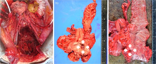 Operative finding after tumor resection (a) and surgical specimen (b, c). Arrows show the tumor that directly invaded the rectum.