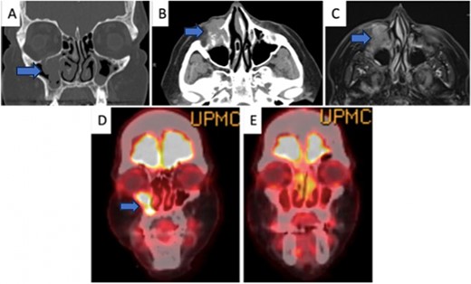 (A) Coronal CT (bone window) depicting the involvement of the tumor in the maxillary sinus extending into the lacrimal duct. (B) Axial CT (soft tissue window) of the tumor showing extent of involvement in the bone and surrounding soft tissue structures. (C) Axial MR of a similar window to Fig. 1B. (D) Initial coronal PET-CT depicting the avidity of the tumor before treatment. (E) Post-treatment PET-CT showing a significant reduction in uptake to the tumor.