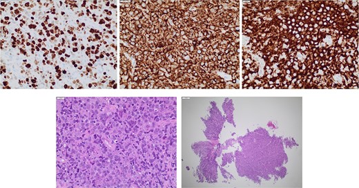 Pathology studies on the incisional biopsy, including CD20 and leukocyte common antigen. FISH high-grade lymphoma panel with IGH/BCL-2 fusion positivity, with gains but not rearrangements of BCL6 and MYC.