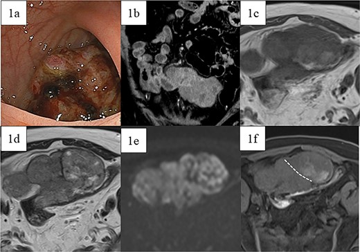Preoperative images. (a) Lower gastrointestinal endoscopy revealed a type 1 tumor in the sigmoid colon. (b) Contrast-enhanced computed tomography showed a contrast-enhanced soft-tissue tumor measuring 80 mm × 95 mm × 45 mm (arrow), which was partially adherent to the small intestine. MRI showed a tumor that was heterogeneous in both (c) T1- and (d) T2-weighted images with predominantly low-intensity areas, with some high-intensity areas in T2. (e) Diffusion-weighted images showed high intensity throughout the entire tumor. Contrast-enhanced MRI (f) showed two areas with slightly different contrast effects. White dotted lines indicate boundaries of the areas with different contrast effects.