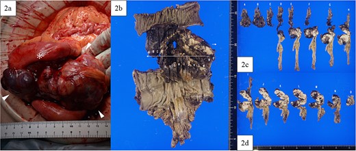 Intraoperative findings and macroscopic study of the surgical specimen. (a) Intraoperative findings showed a tumor (arrowhead) arising from the sigmoid colon and adherent to the small intestine (asterisk), with a white and solid area and a dark red and friable area. (b) Macroscopic study of the surgical specimen after formalin fixation. The high anterior resected specimen with partial resection of the small intestine predominantly had white and solid components, with dark red and fragile components on the small intestinal side and in the lumen of the sigmoid colon. (c, d) All resection margins, including proximal, distal, and circumferential margins, were negative.