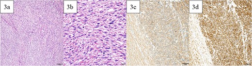 Pathological findings. (a) In the white and solid component, proliferating spindle-shaped cells with eosinophilic cytoplasm in intricate bundles were noted. (b) Uniform atypical spindle-shaped cells proliferated, and nuclear fission was observed in scattered images. The tumor cells were positive for αSMA (c) and desmin (d). Bars indicate 100 μm in Fig. 5a, 20 μm in Fig. 5b, and 50 μm in Fig. 5c and d.