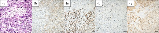 Pathological findings. In the dark red and fragile component, a high degree of atypical and pleomorphic tumor cell growth was observed (a). The tumor cells were positive for αSMA (b), desmin (c), MDM2 (d), and CDK4 (e). Bars indicate 50 μm in Fig. 6a–e.