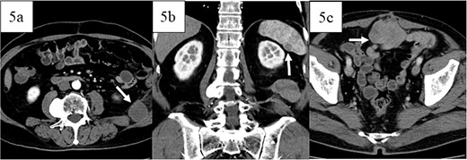 Images of contrast-enhanced computed tomography, contrast-enhanced computed tomography scan revealed recurrence in the retroperitoneum 12 months postoperatively (white arrow in 5a) and metastases in the spleen 16 months postoperatively (white arrow in 5b), and peritoneal dissemination (white arrow in 5c) 27 months postoperatively.