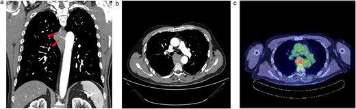 Radiologic findings. (a) A 15-cm soft tissue shadow in the posterior mediastinum of Th6-10, presenting as a multinodular mass. (b) Thoracic paravertebral soft tissue mass in the axial view. (c) Image of positron emission tomography-CT.