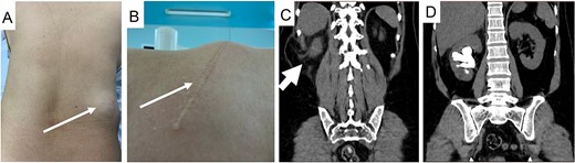 Images of the patient with right flank incision and hernia bulge with clinical picture (A and B, thin arrow), hernia sac on CT scan (C, thick arrow), and staghorn stone (D).