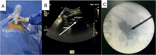 US guidance with carefully exclude bowel during renal puncture (A), real-time US showed the stone and its acoustic shadow (B, arrow), and tract dilation using safety guidewire on fluoroscopy monitor (C).