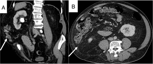 Patient’s CT scan shows right UPJ stone (A) and lumbar hernia with mesentery inside (A and B, arrow).
