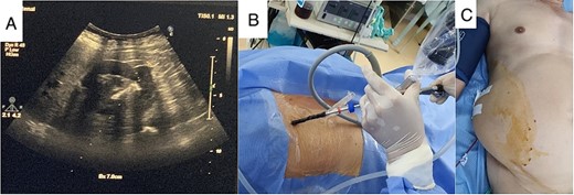 Real-time US guide for renal puncture (A), mini PCNL with lateral position (B), and nephrostomy after completing stone clearance (C).