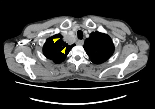 Pretreatment chest computed tomography (CT) image. The arrowheads highlight locally advanced lung cancer invading the chest wall and brachiocephalic trunk (cT4N0M0).