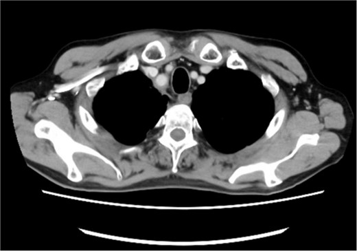 Posttreatment computed tomography (CT) image. No apparent tumorous lesions were identified.