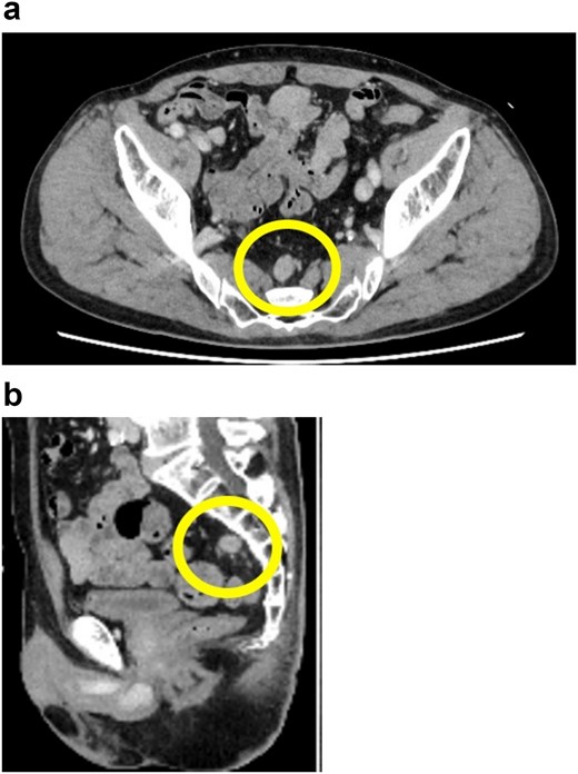 Preoperative pelvic computed tomography (CT) image. The circle indicates the nodule located in the mesorectum. (a) Horizontal view. (b) Sagittal view.