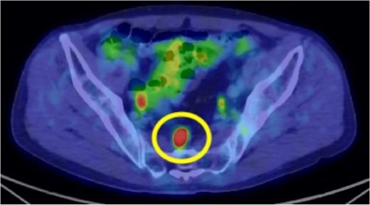 Preoperative 18F-fluorodeoxyglucose (FDG) positron emission tomography (PET)/computed tomography (CT) image. The circle highlights the nodule located in the mesorectum with a maximum standardized uptake value (SUVmax) of 10.3.